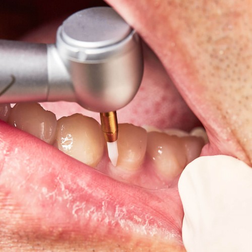 Surgical/Extraction