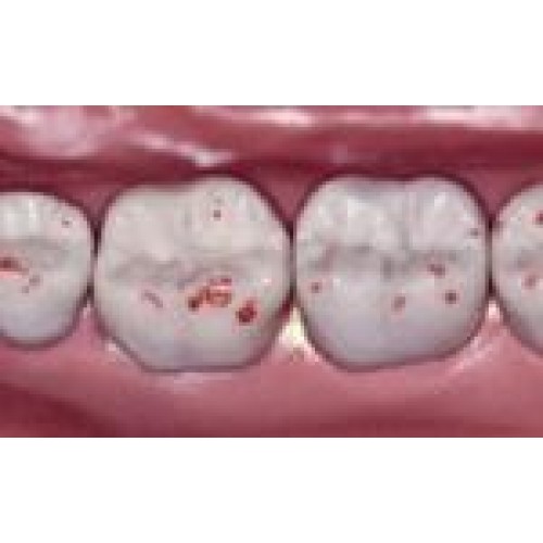 Dental Consumables