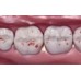 Dental Consumables